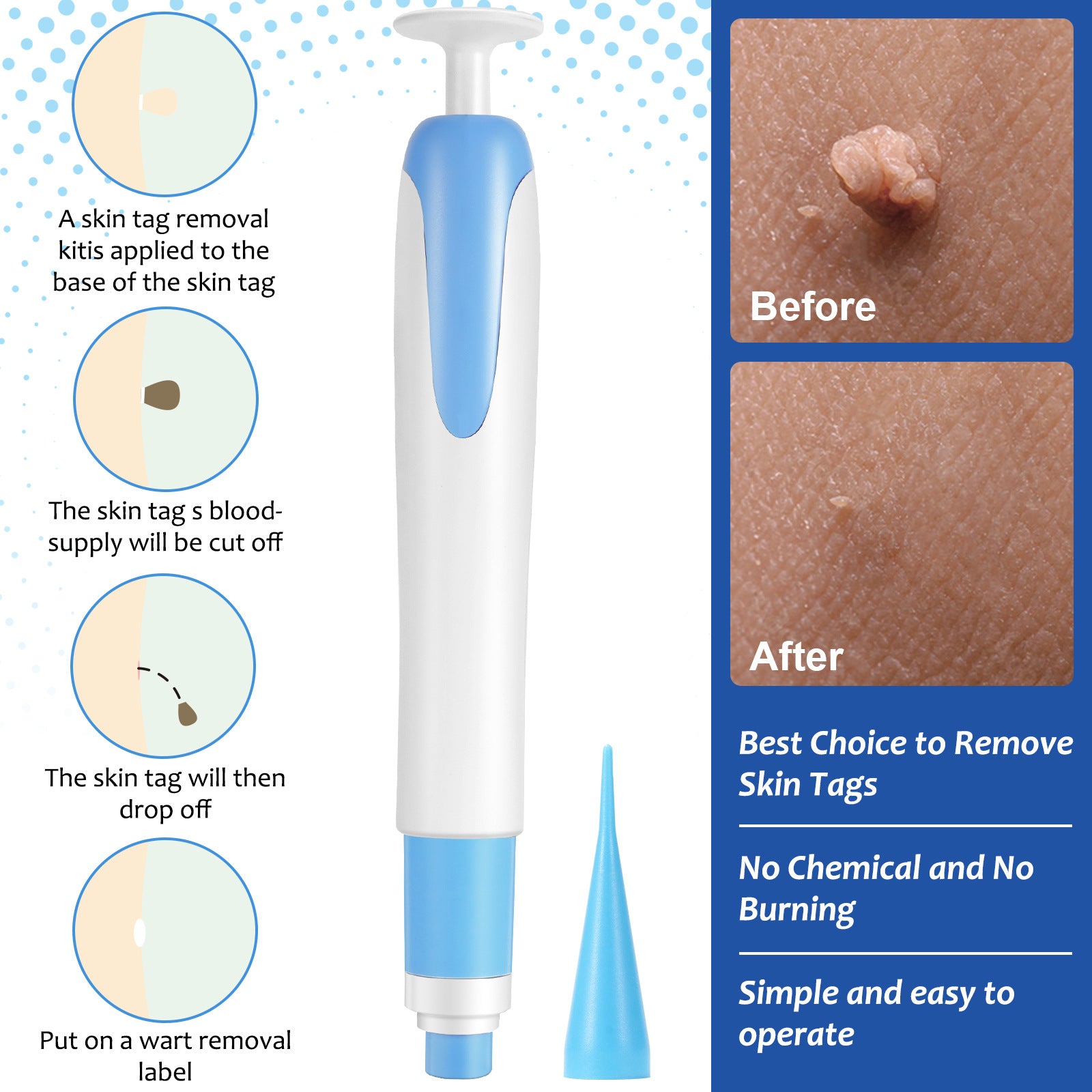Big Head Wart Pen Set Skin Tag Removal Kit